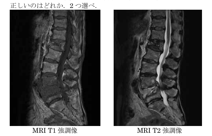 第38回問23 腰椎MRI T1/T2強調矢状断像