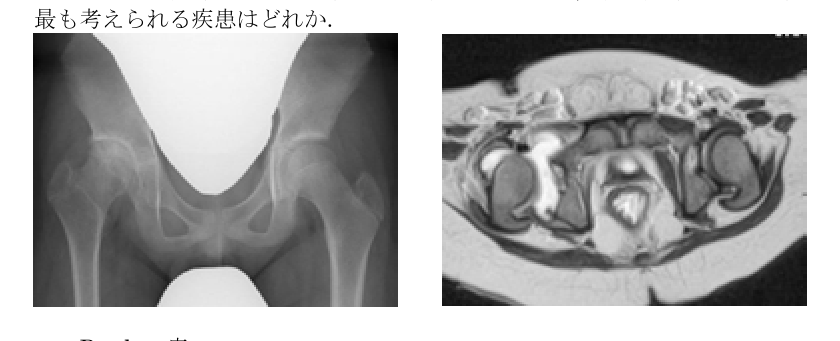 第38回問30 両股関節X線・MRI