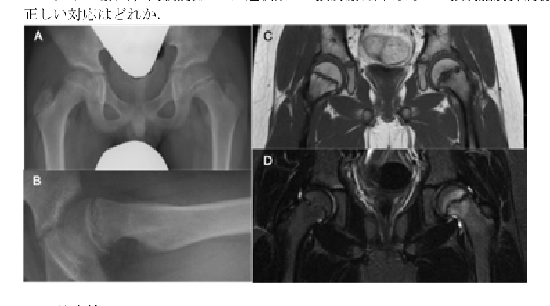 第38回問35 両股関節X線・MRI（SCFE）