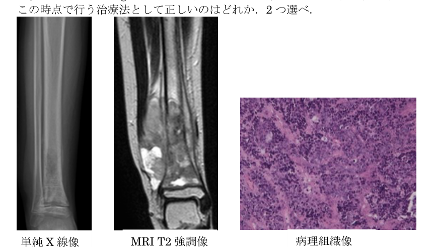 第38回問40 右下腿X線・MRI・病理