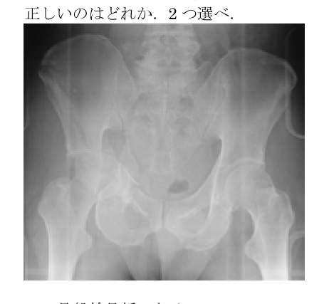 第38回問81 骨盤X線正面像