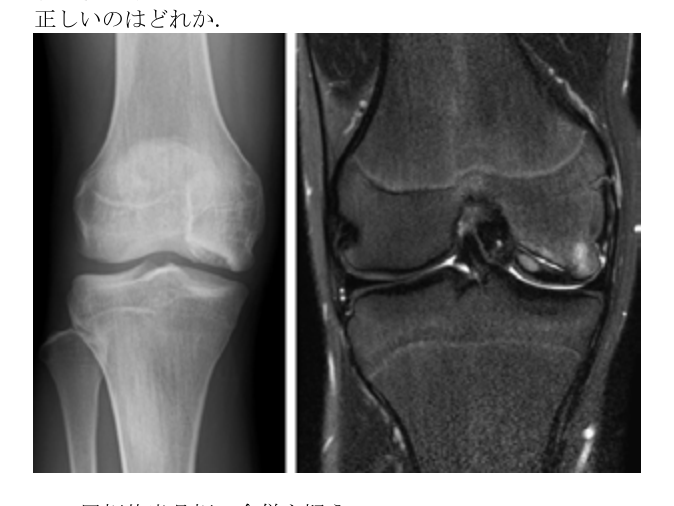 第38回問91 膝関節X線・MRI（OCD）