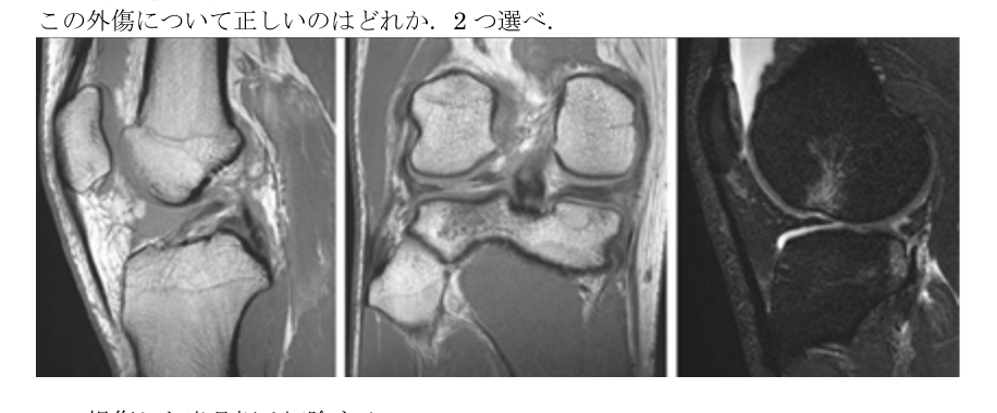 第38回問92 右膝MRI