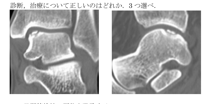 第38回問93 足関節CT（距骨OCD）